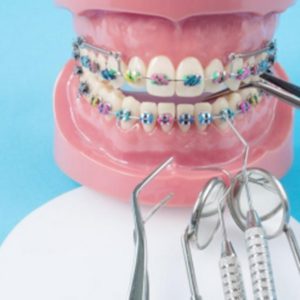 braces-teeth-whitening