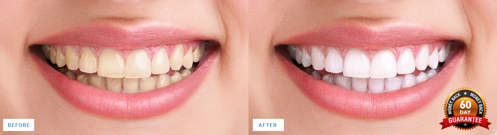 before-after-teeth-whitening-results